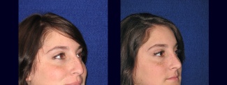 Right 3/4 View - Rhinoplasty