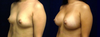 Left 3/4 View - Breast Augmentation - Silicone Implants