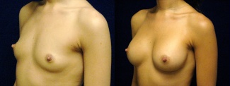 Left 3/4 View - Breast Augmentation - Silicone Implants