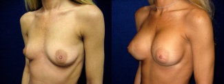 Left 3/4 View - Breast Augmentation