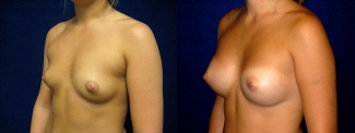 Left 3/4 View - Breast Augmentation - Silicone Implants