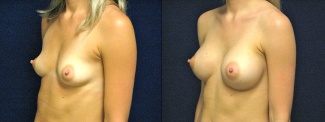 Left 3/4 View - Breast Augmentation - Silicone Implants