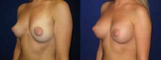 Left 3/4 View - Breast Augmentation - Saline Implants