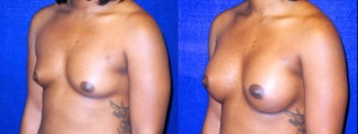 Left 3/4 View - Breast Augmentation