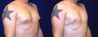 Right 3/4 View - Male Breast Reduction