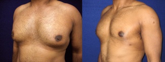 Left 3/4 View - Male Breast Reduction