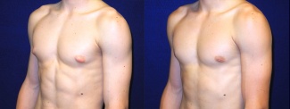 Left 3/4 View - Male Breast Reduction