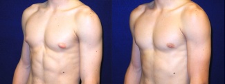 Left 3/4 View - Male Breast Reduction