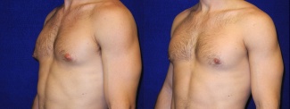 Left 3/4 View - Male Breast Reduction