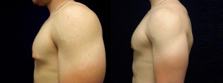 Left Profile View - Male Breast Reduction