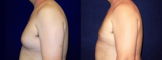 Left Profile View - Male Breast Reduction