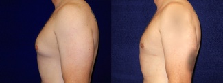 Left Profile View - Male Breast Reduction