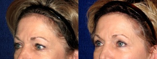 Left 3/4 View - Upper Eyelid Surgery