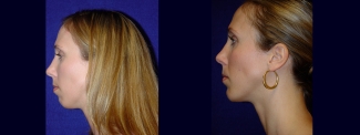 Left Profile View - Chin Implant