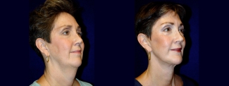 Right 3/4 View - Facelift & Chin Implant