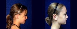 Right Profile View - Otoplasty