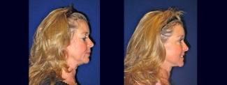 Right Profile View - Facelift with Upper and Lower Eyelid Surgery and Browlift