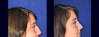 Right Profile View - Rhinoplasty