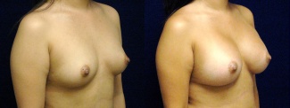 Right 3/4 View - Breast Augmentation - Silicone Implants