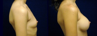 Right Profile View - Breast Augmentation - Silicone Implants