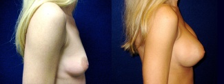 Right Profile View - Breast Augmentation