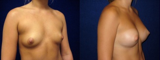 Right 3/4 View - Breast Augmentation - Silicone Implants