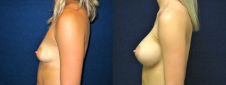 Left Profile View - Breast Augmentation - Silicone Implants