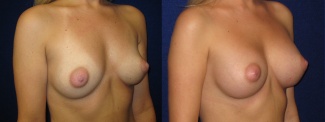 Right 3/4 View - Breast Augmentation - Saline Implants