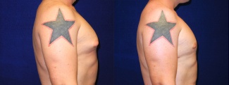 Right Profile View - Male Breast Reduction