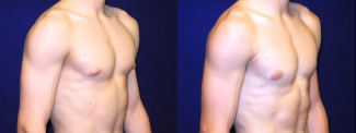 Right 3/4 View - Male Breast Reduction