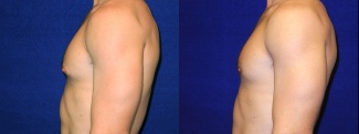 Left Profile View - Male Breast Reduction