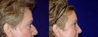 Right Profile View - Browlift and Rhinoplasty