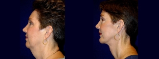 Left Profile View - Facelift & Chin Implant