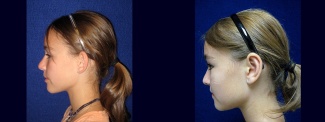 Left Profile View - Otoplasty