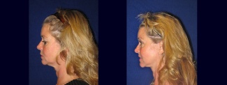 Left Profile View - Facelift with Upper and Lower Eyelid Surgery and Browlift