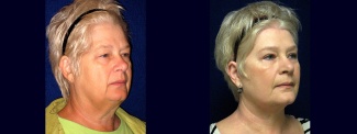 Right 3/4 View - Facelift with Upper and Lower Eyelid Surgery and Browlift