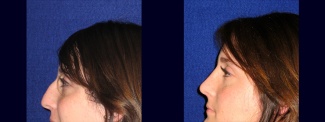 Left Profile View - Rhinoplasty