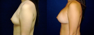 Left Profile View - Breast Augmentation - Silicone Implants