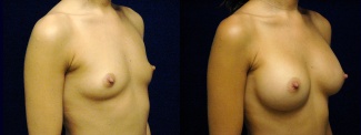 Right 3/4 View - Breast Augmentation - Silicone Implants