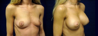 Right 3/4 View - Breast Augmentation