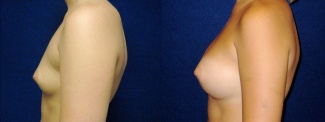 Left Profile View - Breast Augmentation - Silicone Implants