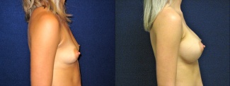 Right Profile View - Breast Augmentation - Silicone Implants