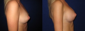 Right Profile View - Breast Augmentation - Saline Implants