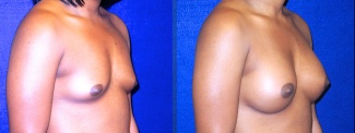 Right 3/4 View - Breast Augmentation