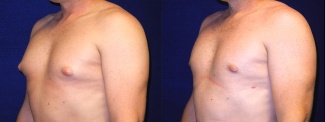 Left 3/4 View - Male Breast Reduction