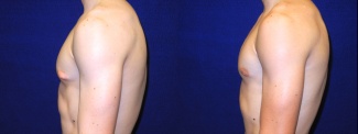 Left Profile View - Male Breast Reduction