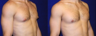 Right 3/4 View - Male Breast Reduction