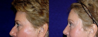 Right Profile View - Browlift and Rhinoplasty