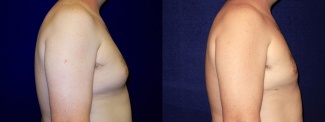 Right Profile View - Male Breast Reduction