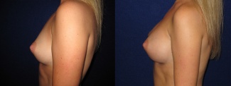Left Profile View - Breast Augmentation - Saline Implants